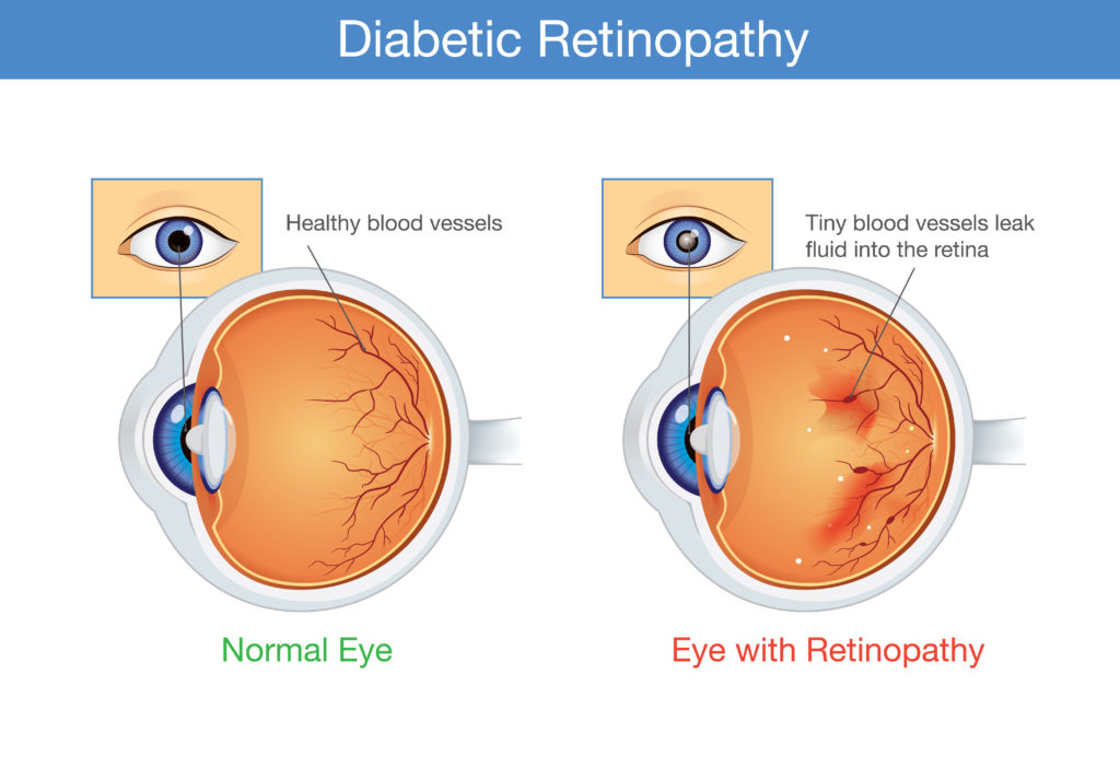 Diabetic Retinopathy FAQs