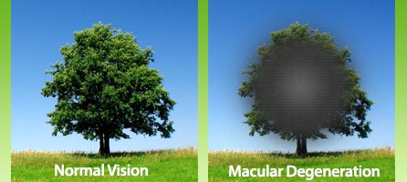 Macular Hole Vision