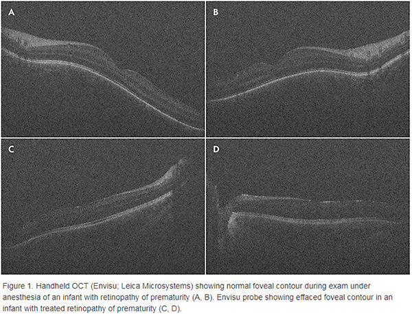 Intraoperative OCT for Vitreoretinal Surgery