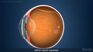 Baltimore Retinal Detachment