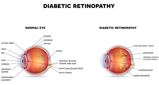 diabetic macular edema