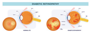 Diabetic retinopathy Baltimore 