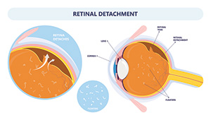 laser photocoagulation for diabetic eye disease