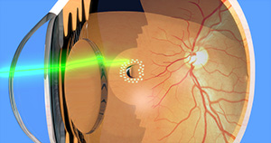 barricade laser treatment for retinal detachment