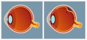 Retinal Tear Illustration