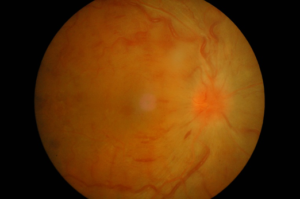 Retinal Vein Occlusion Treatment Baltimore