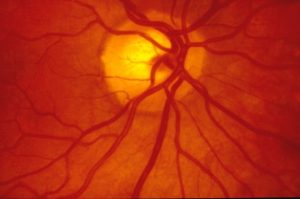 Fluorescein angiography procedure Baltimore