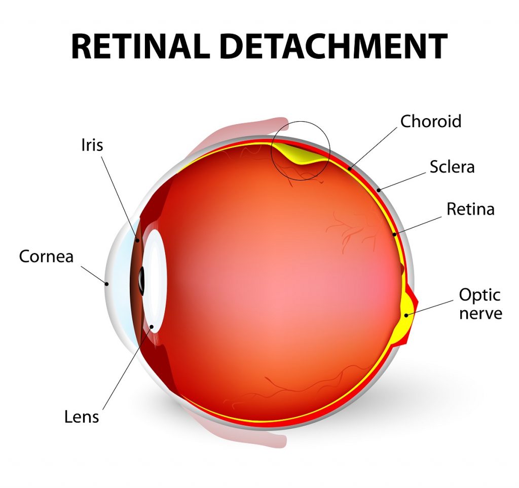 Retinal Detachment Infographic