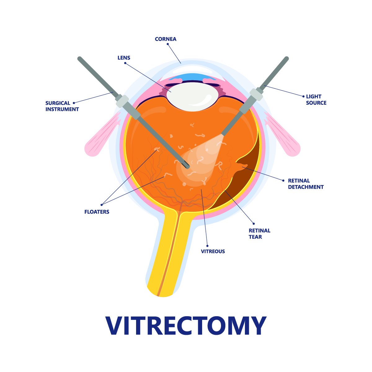 Vitrectomy in Baltimore