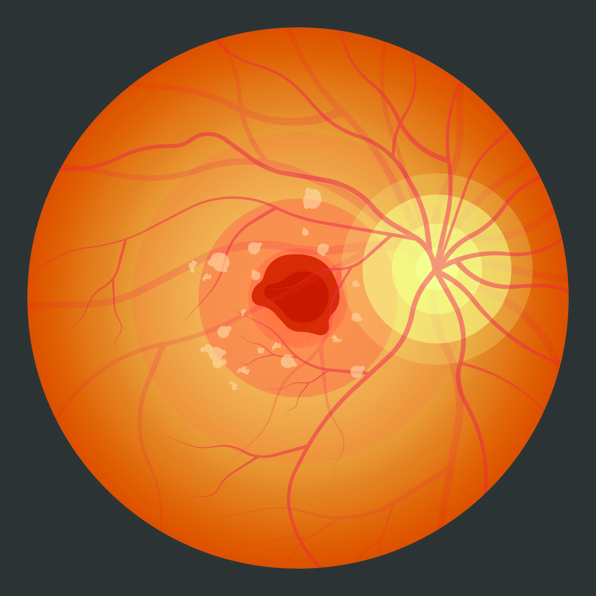 What Causes Macular Edema? - Elman Retina Group