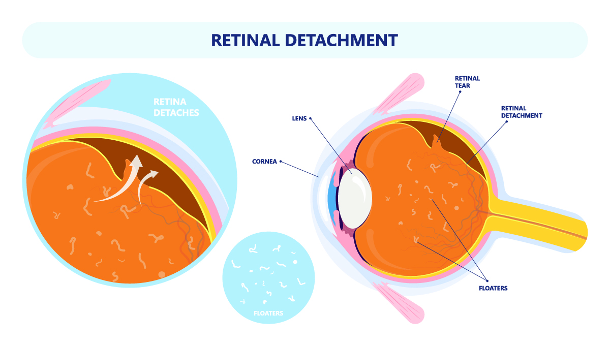 retinal detachment treatment Pikesville