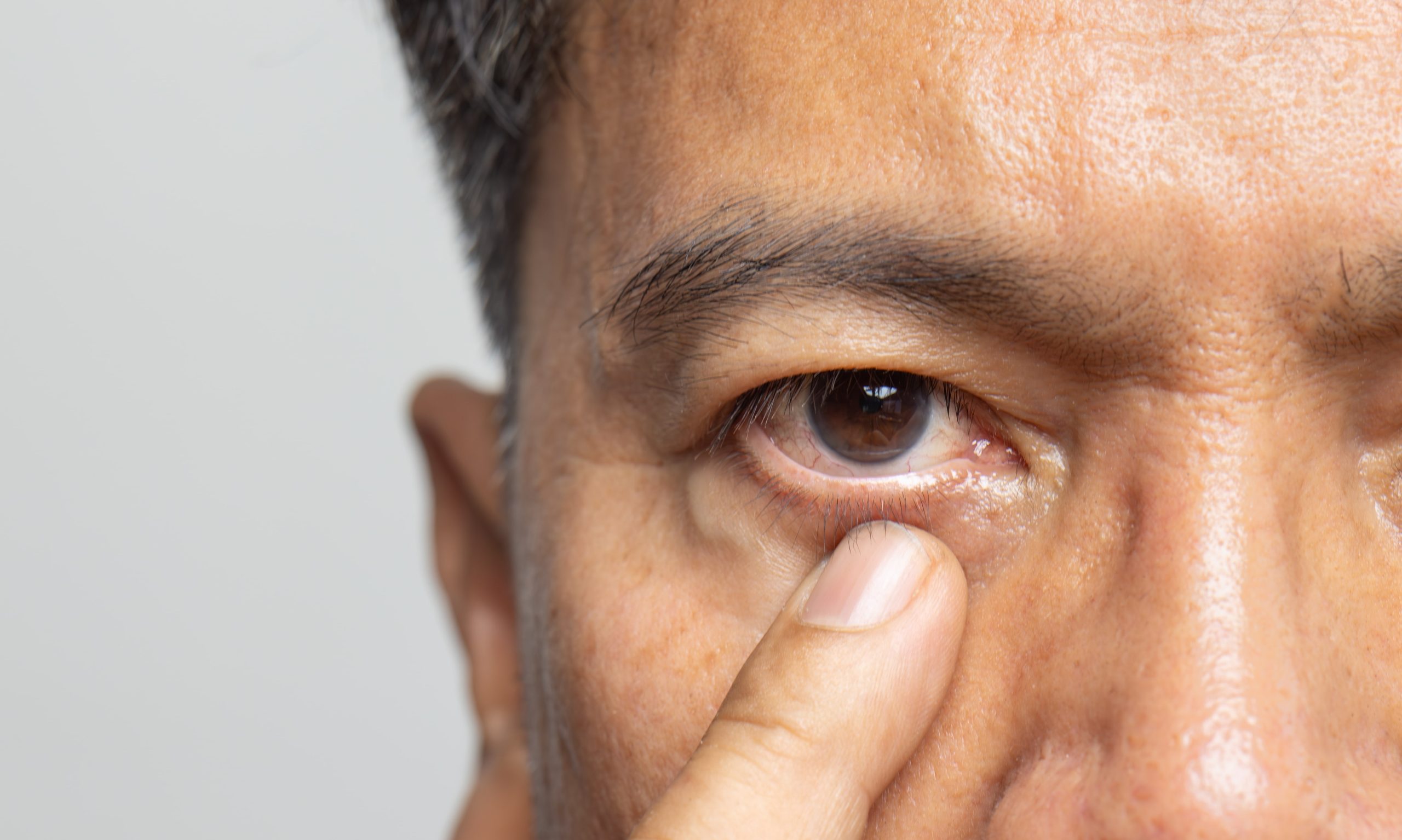 Older man with cataracts has a slight risk for macular edema after surgery