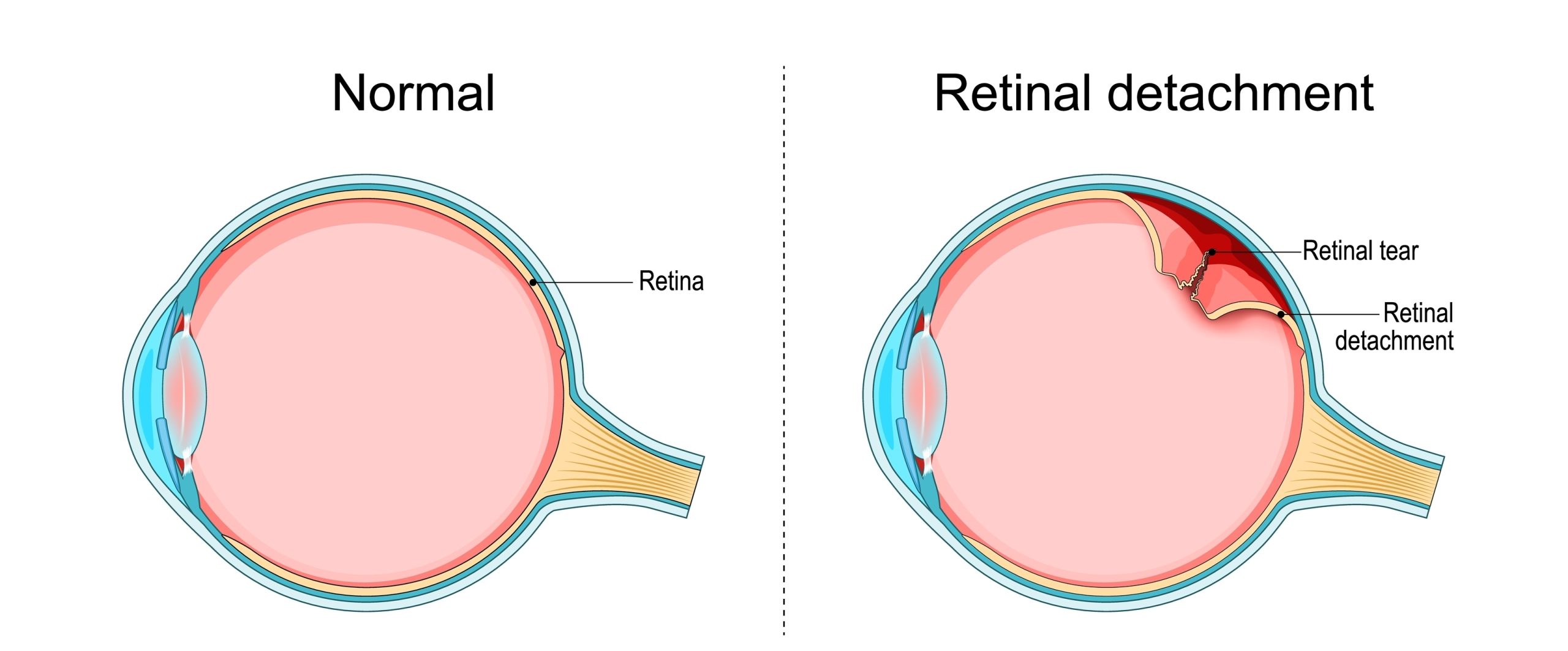 Retinal Detachment Treatment in Catonsville, Pikesville, Glen