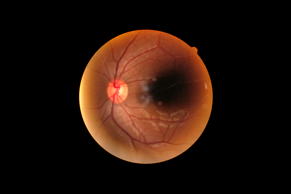 Portrayal of abnormal retina.